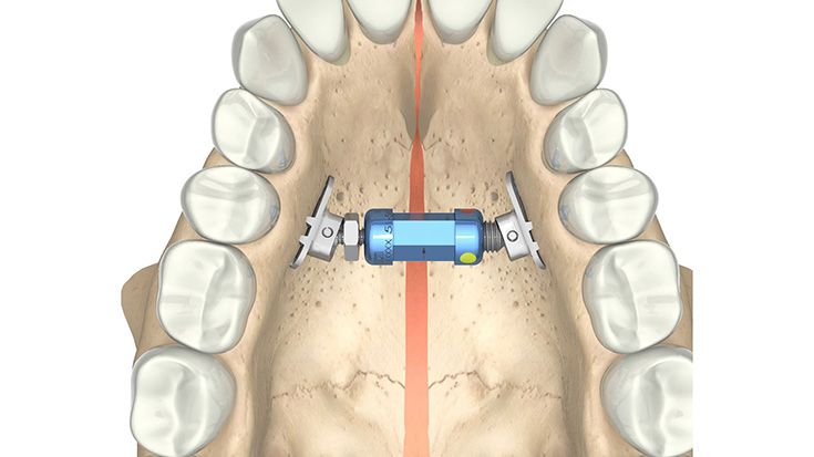 Rapid-Palatal-Expander (RPE)