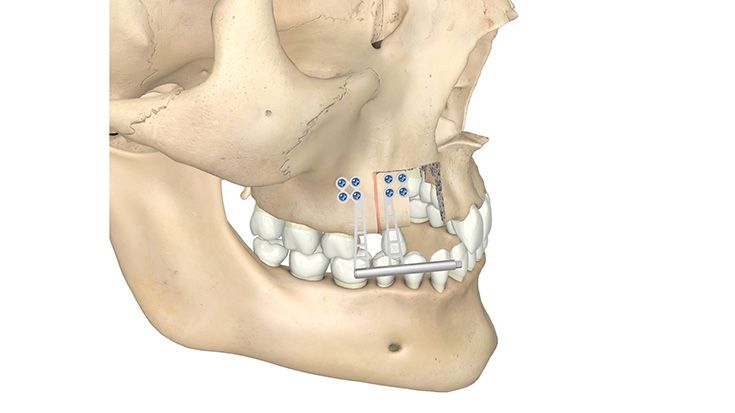 Liou-Cleft-Distraktor