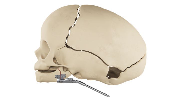 NEW | HyperDrive Mandibular Distractors