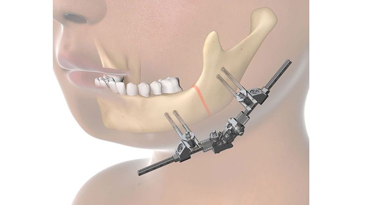  3D Xternal distractor