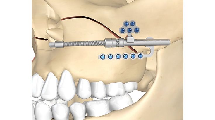 Zürich-Pediatric-Maxillary-Distraktor