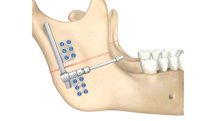 Right-Angle-Driven-Distraktor (RAD)