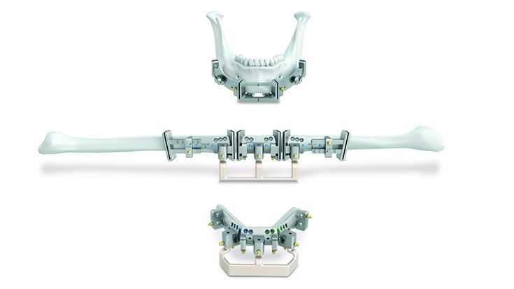 L1® Mandible ReconGuide