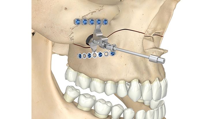 TS-MD-Distraktor