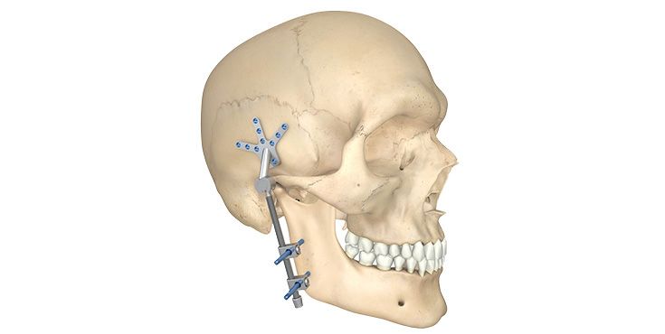 Kranio-Mandibular-Fixateur nach Matthews