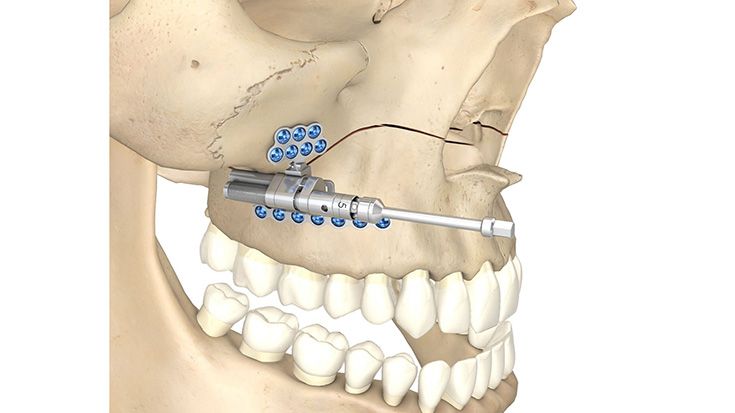 Maxillary-Telescoping-Distraktor