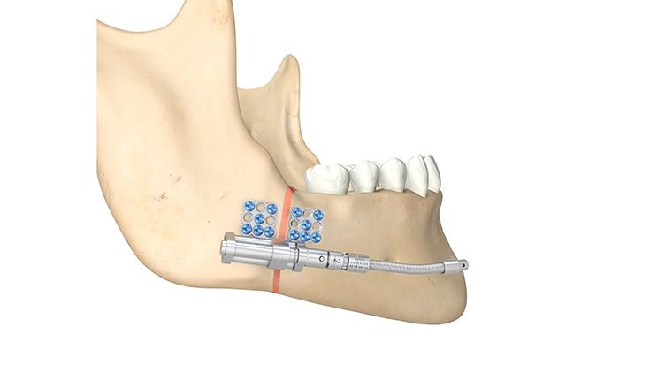 Mandibular-Telescoping-Distraktor