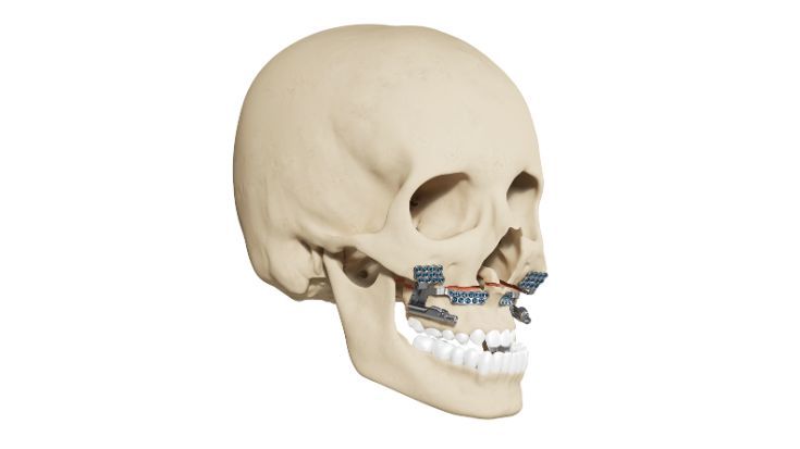 HyperDrive Maxillary Distractors